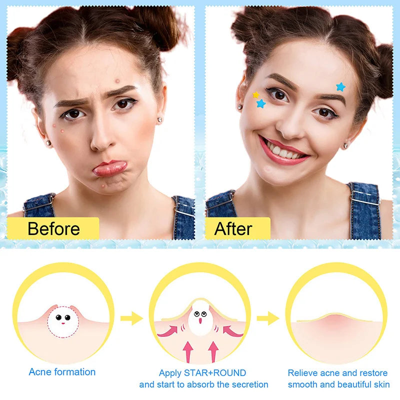 Acne Pimple Patches